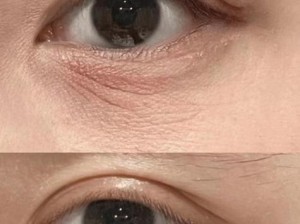 7个简单的眼部消肿法（告别浮肿，拥有明亮的双眸）