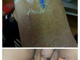 揭露魏则西的悲惨遭遇（一个年轻的生命被逼上绝路）